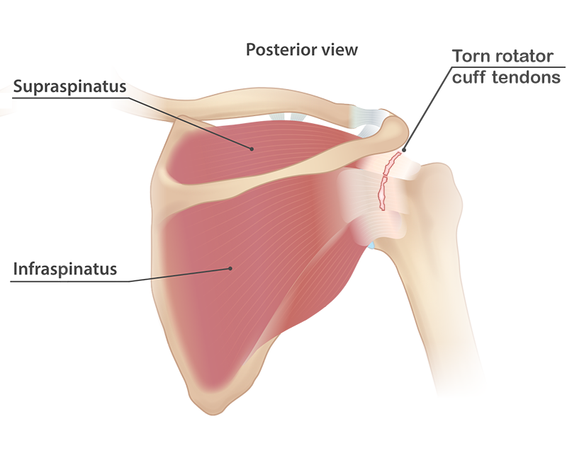 A rough sketch of the injury. Image source: InjuryMap.