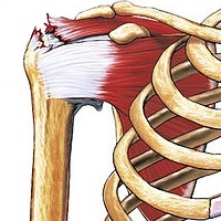 Rotator cuff tear. Image source: Nucleus Communications.