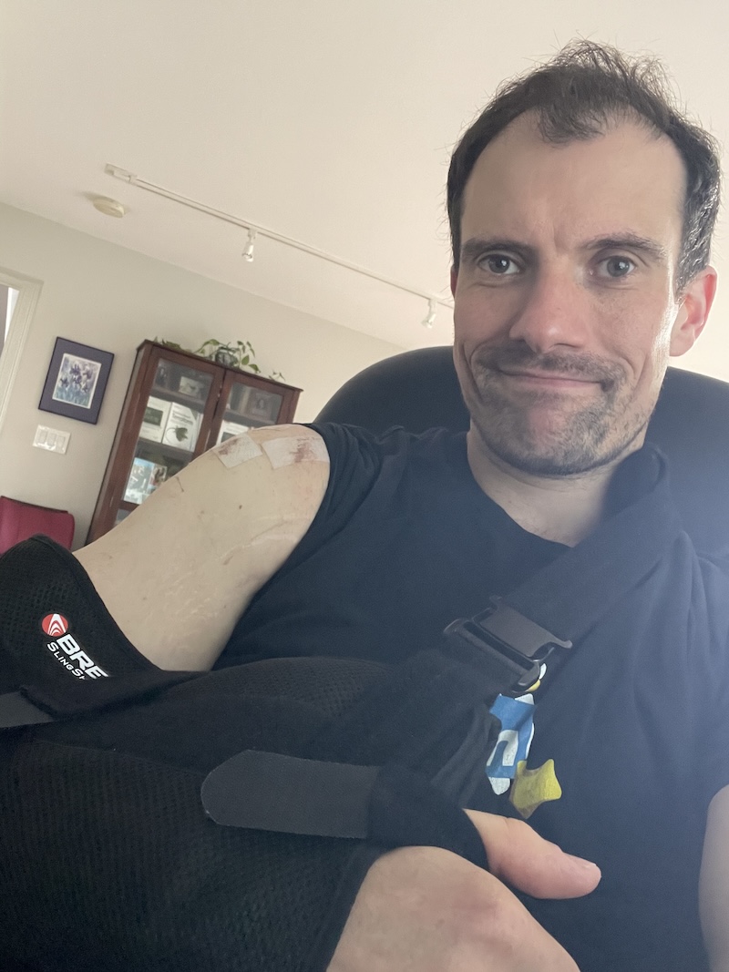Me a few days after the surgery, with a sling, and a swollen upper arm.